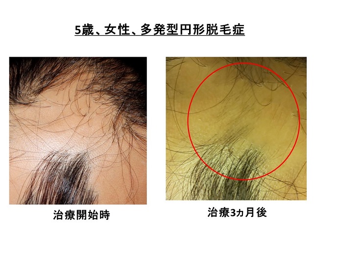 円形脱毛症　病院